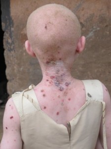 Child with albinism