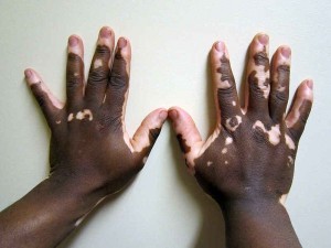 Mara nyingi ugonjwa wa vitiligo hushambulia kwenye viungo